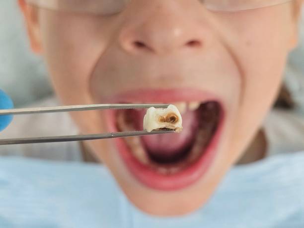 Best Broken or Chipped Tooth Repair in Mitchellville, IA